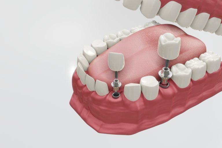 The Longevity of Dental Implants: Insights from Dr. Ammar Mousa at Village Smiles
